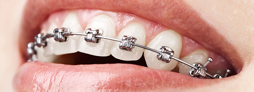 Ortodoncia | Clínica Dental en Granollers