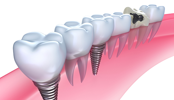 Implantología dental