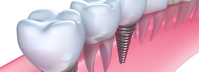  Implantología dental  | Dentistas en Granollers 